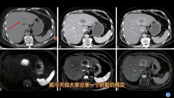 48岁男性，发现肝脏结节，做了CT和MRI，诊断什么疾病？