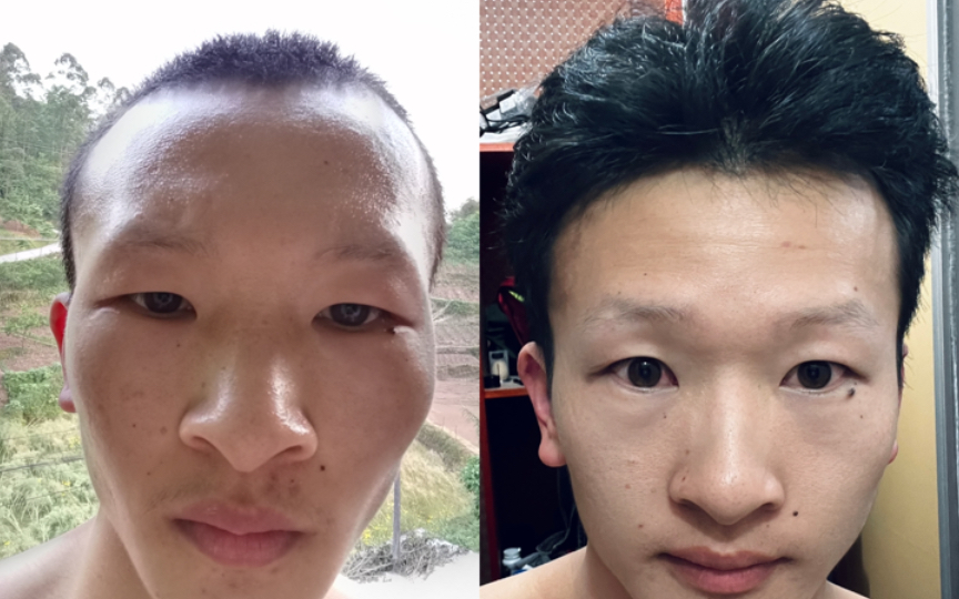 秃头男研究生养发经验4