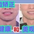 北京牙齿矫正杨磊正畸案例：牙缝大、深覆盖深覆合|牙齿矫正让健康和美观并存