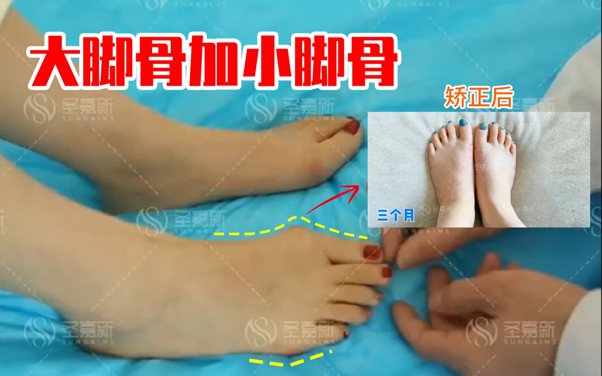 苏敬达大拇指外翻小脚骨一起手术整体脚掌变窄脚型变好看
