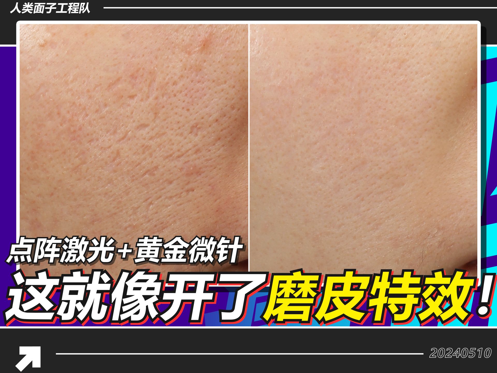 这怕不是磨了皮吧？痘坑消失的无影无踪！【点阵激光+黄金微针】