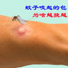 蚊子咬起的包为啥越挠越痒