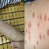 女子一觉醒来身上奇痒无比，爆出密密麻麻红疹子，近期多人中招