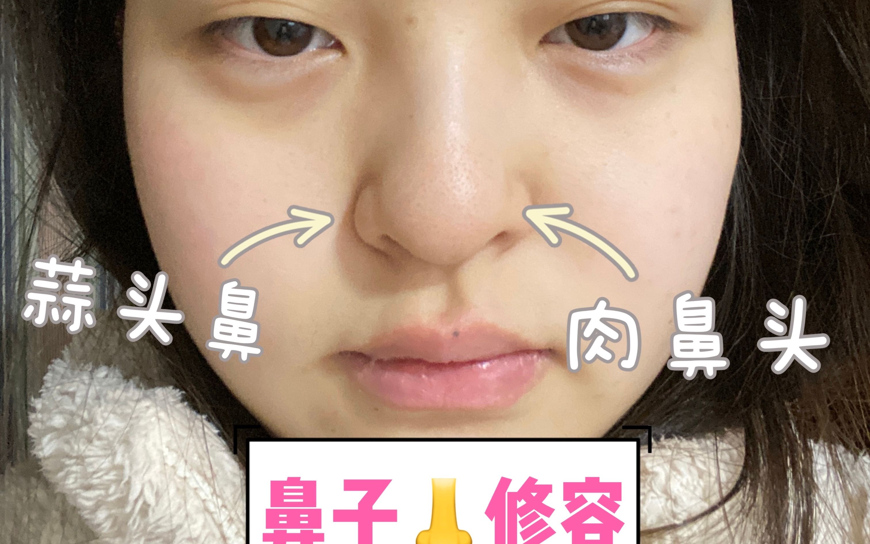 什么样的鼻型才是最好看的鼻型-徐荣阳副主任医师-爱问医生