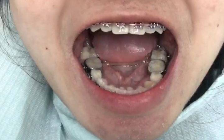 深覆合深覆盖戴牙套3年8个月，平导戴了一年，拔了八颗牙，宣布矫正失败了！！！