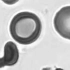 显微镜下的红细胞发生镰刀状改变