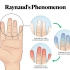 Anatomy U8L1 V2 - Raynaud's Phenomenon