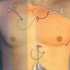3D视频演示全皮下植入除颤仪（S-ICD）手术过程！