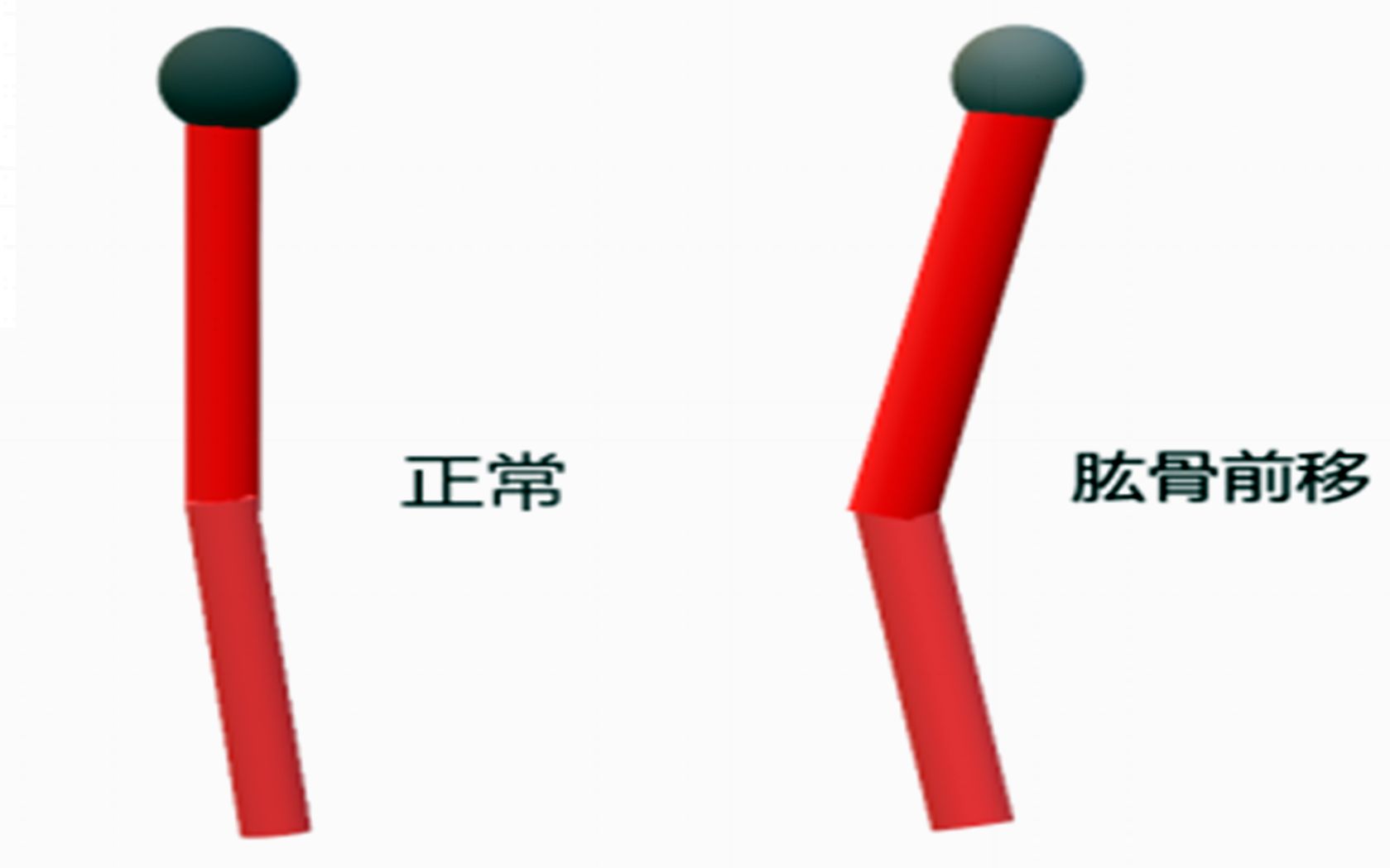 【菠萝君课堂】圆肩并不可怕,肱骨前移才可怕哔哩哔哩 (゜゜)つロ 干杯~bilibili