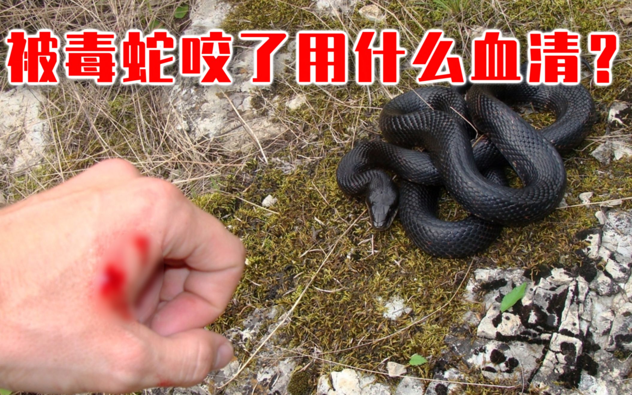 你的转发投币！也许能救人一命？在中国被毒蛇咬了应该用什么血清？