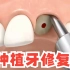 种植牙的修复，植入人造骨粉