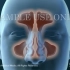 【3D医学动画】慢性鼻窦炎手术治疗（中英双字幕+原版英文）