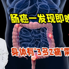 肠癌一发现就是晚期？身体若出现“3多2痛”，尽早检查下肠道