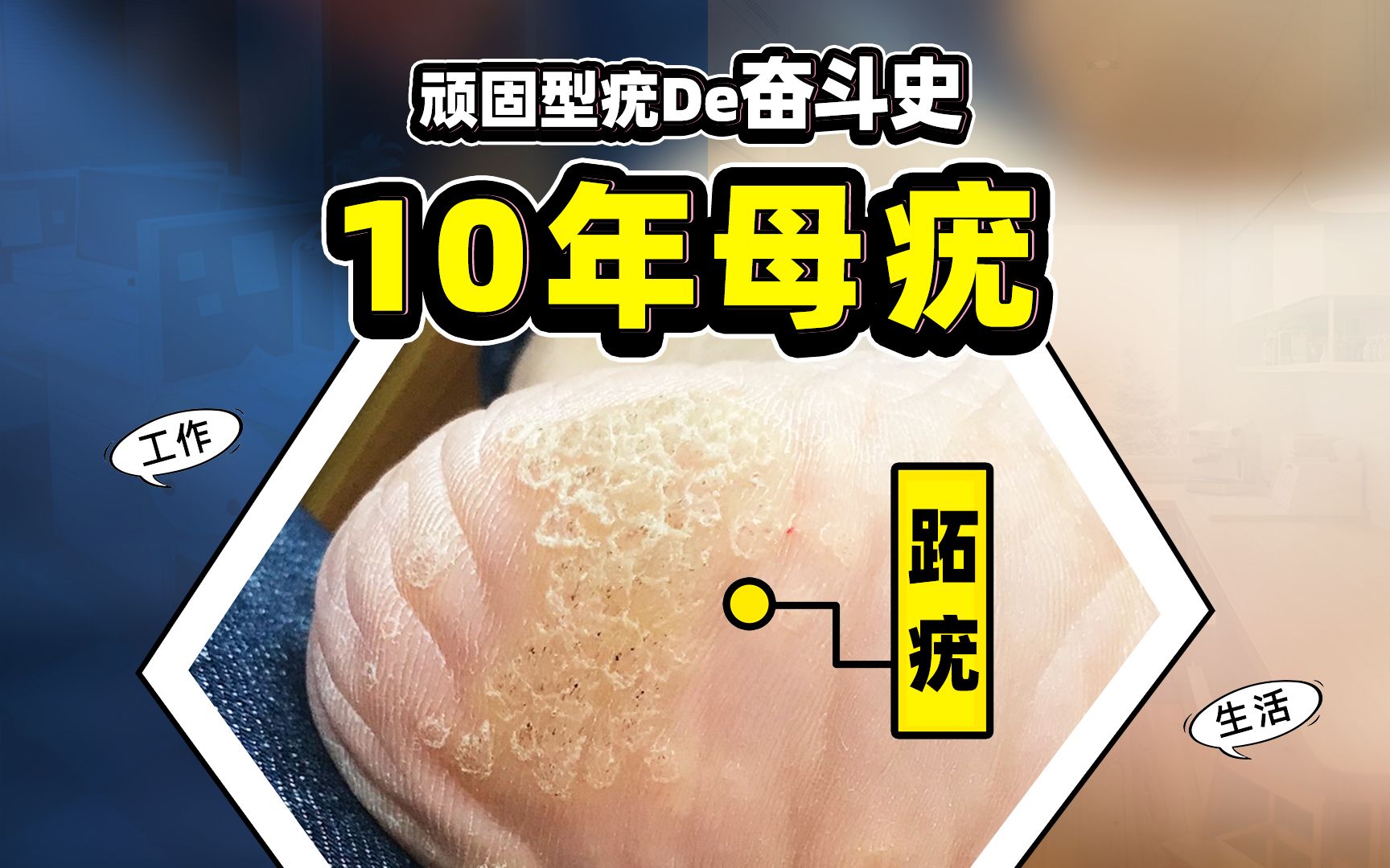 尤克舒医用清疣敷料 肉刺疙瘩跖疣寻常疣瘊子正品水平去用神器-Taobao