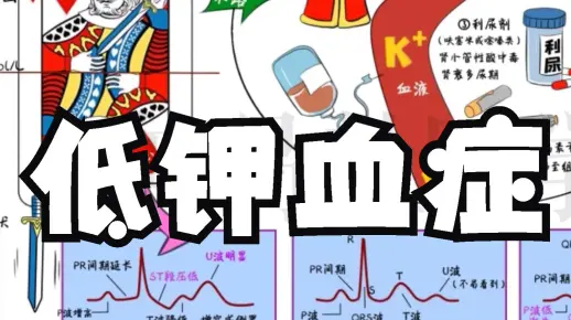 低钾血症 | 定义 病因 机制 临床表现 心电图 处理