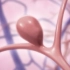三维动画演示，脑动脉瘤的形成和治疗过程#肿瘤#三维动画