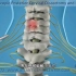 这手术太简单了，椎间孔镜治疗颈椎病手术过程，3D演示。。