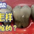 第7集：牙龈萎缩是不可逆的，很难恢复，严重者牙齿脱落！