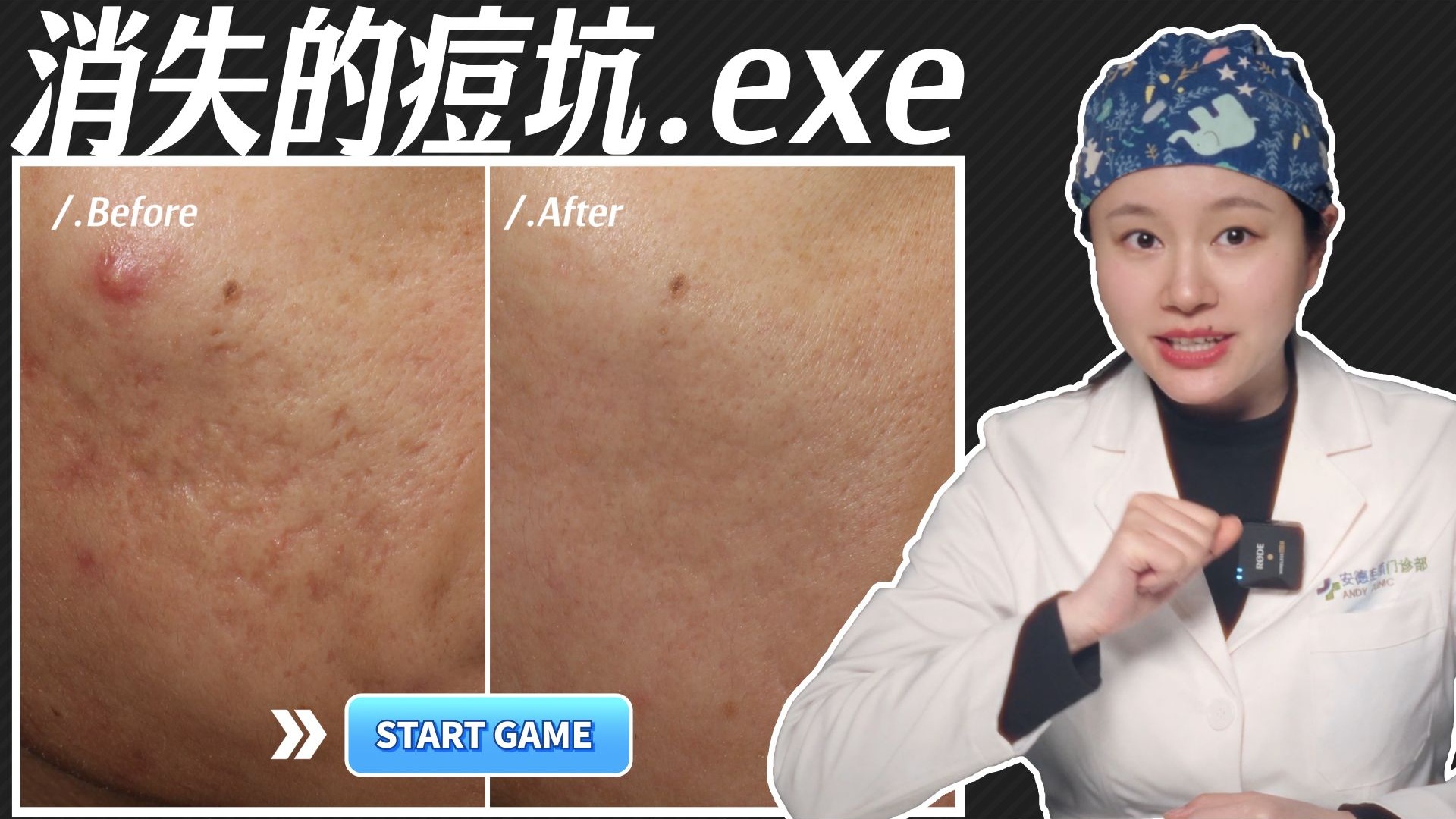 痘坑联合治疗用到四种方法会得到什么效果？点阵激光+黄金微针+皮下剥离+填充