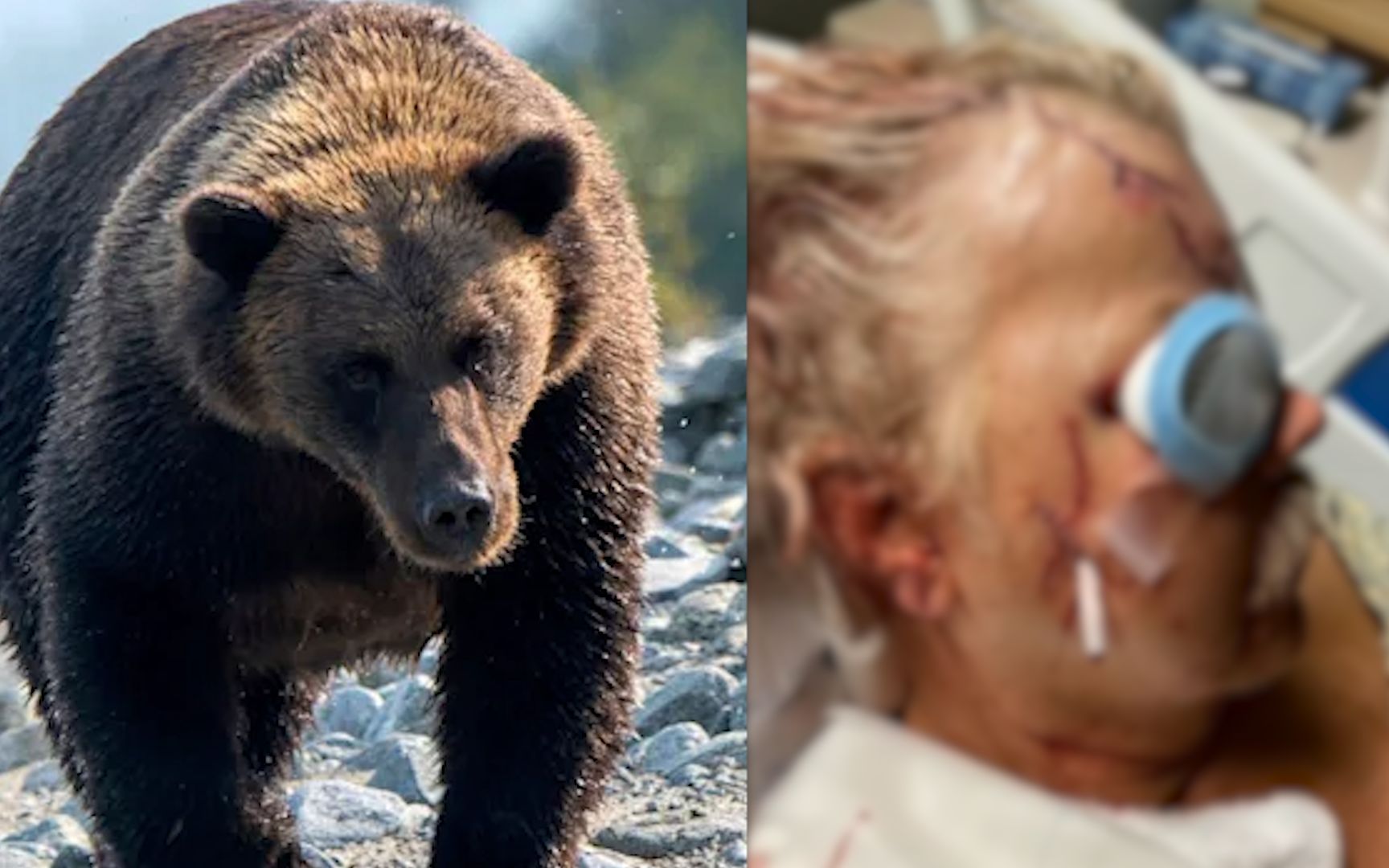 森林突遇136公斤棕熊，美国男子惨遭攻击：头骨碎裂，右半边脸几乎全毁