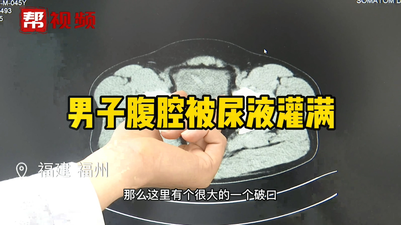 憋尿后男子膀胱爆裂，医生：失血超全身三分之一