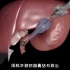 胆囊结石切除手术，3D演示。。