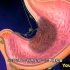 胃癌的发生原因，3D演示。。
