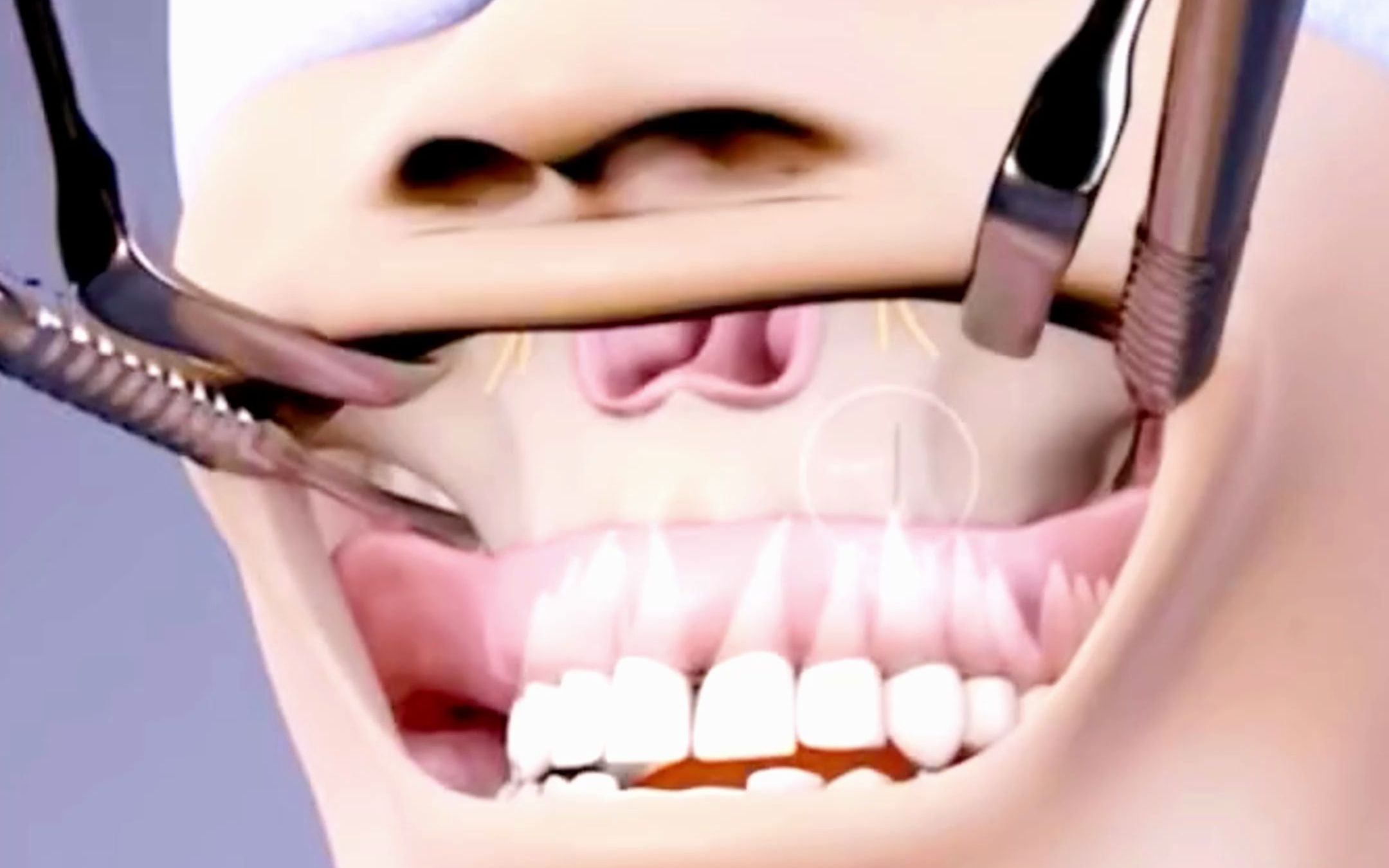 3D演示下颌角手术过程，看完你还想做磨骨吗