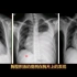 胸部X光片上如何大致判断胸腔积液量？专科医生讲解