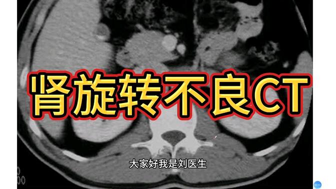 影像报告解读：肾旋转不良的CT表现，专科医生讲解！