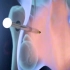 做了输精管结扎影响性功能吗，输精管结扎手术过程，3D演示。。