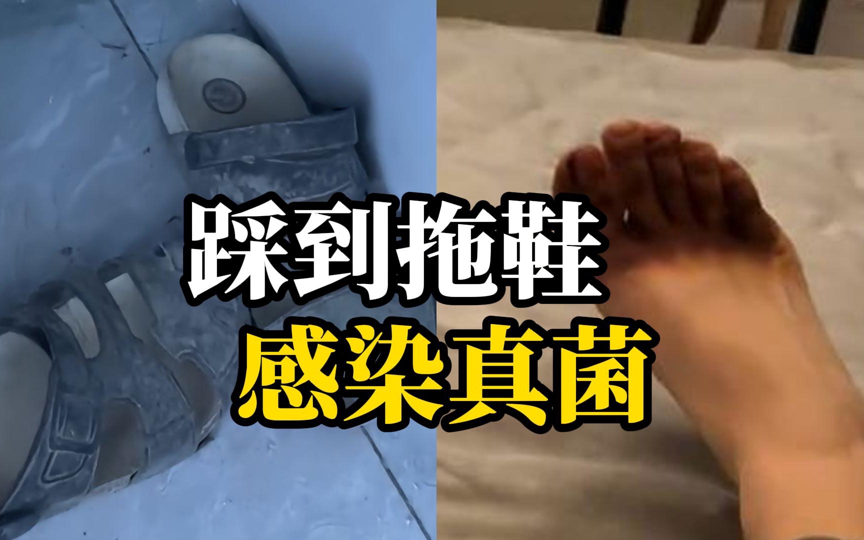 大学生踩到舍友的拖鞋导致双脚脉管炎，200多天仍未恢复