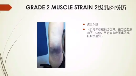 肌肉损伤的临床评估