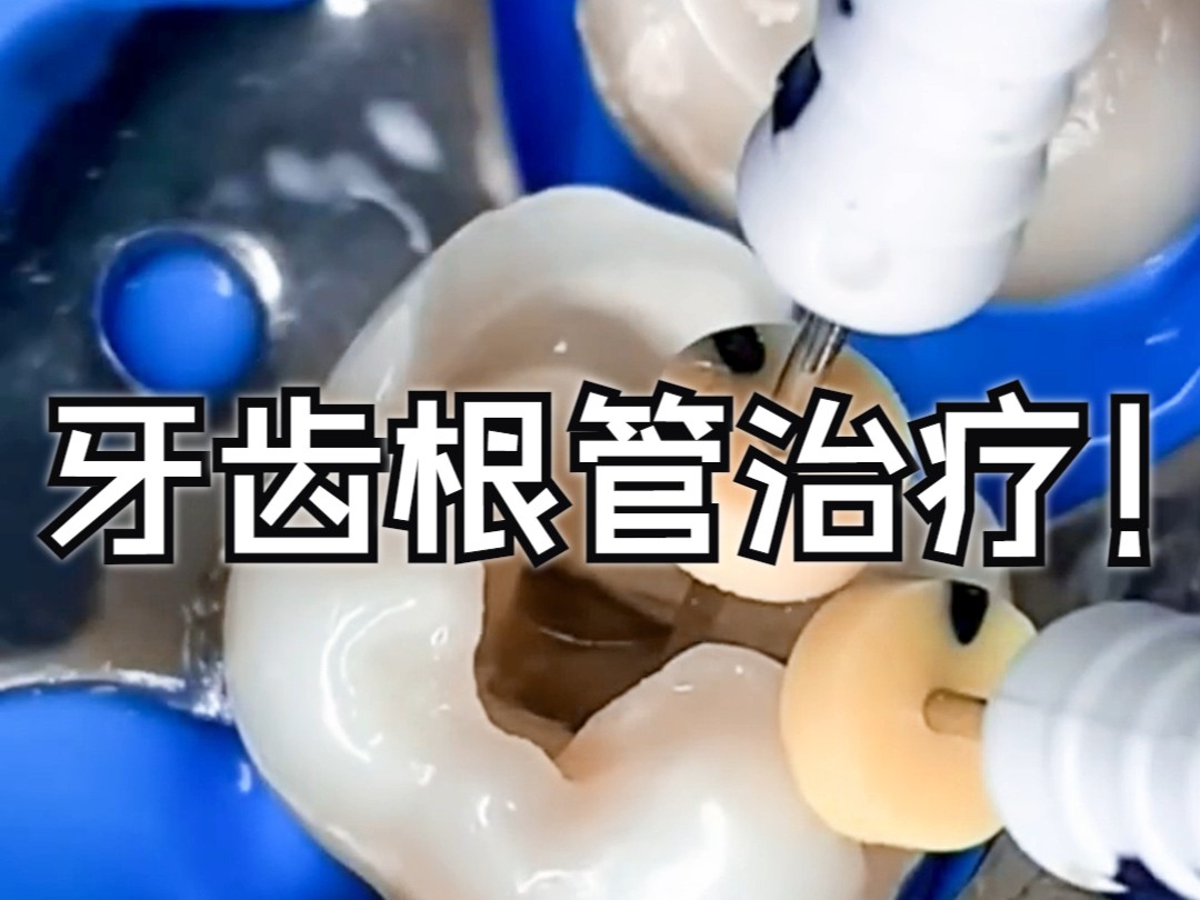 看到这画面，大家做过根管的牙齿是否在隐隐作痛呢？
