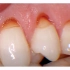 【深圳补牙】牙齿有楔状缺损该怎么办？