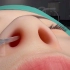 3D动画演示假体隆鼻的过程。