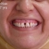 37岁牙齿稀疏矫正案例，恢复了美观和牙齿功能