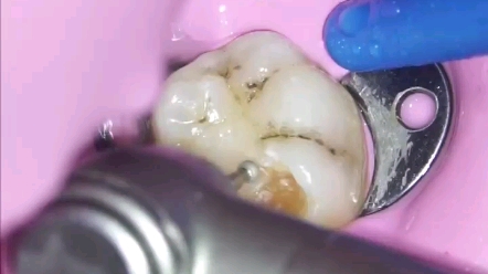 补牙全过程