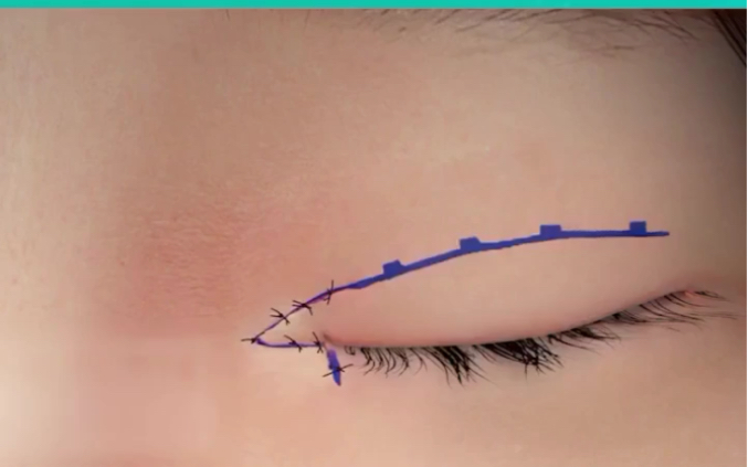 3D动画展示开眼角手术过程