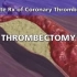 unit3+Video+III+Coronary+Artery+Disease