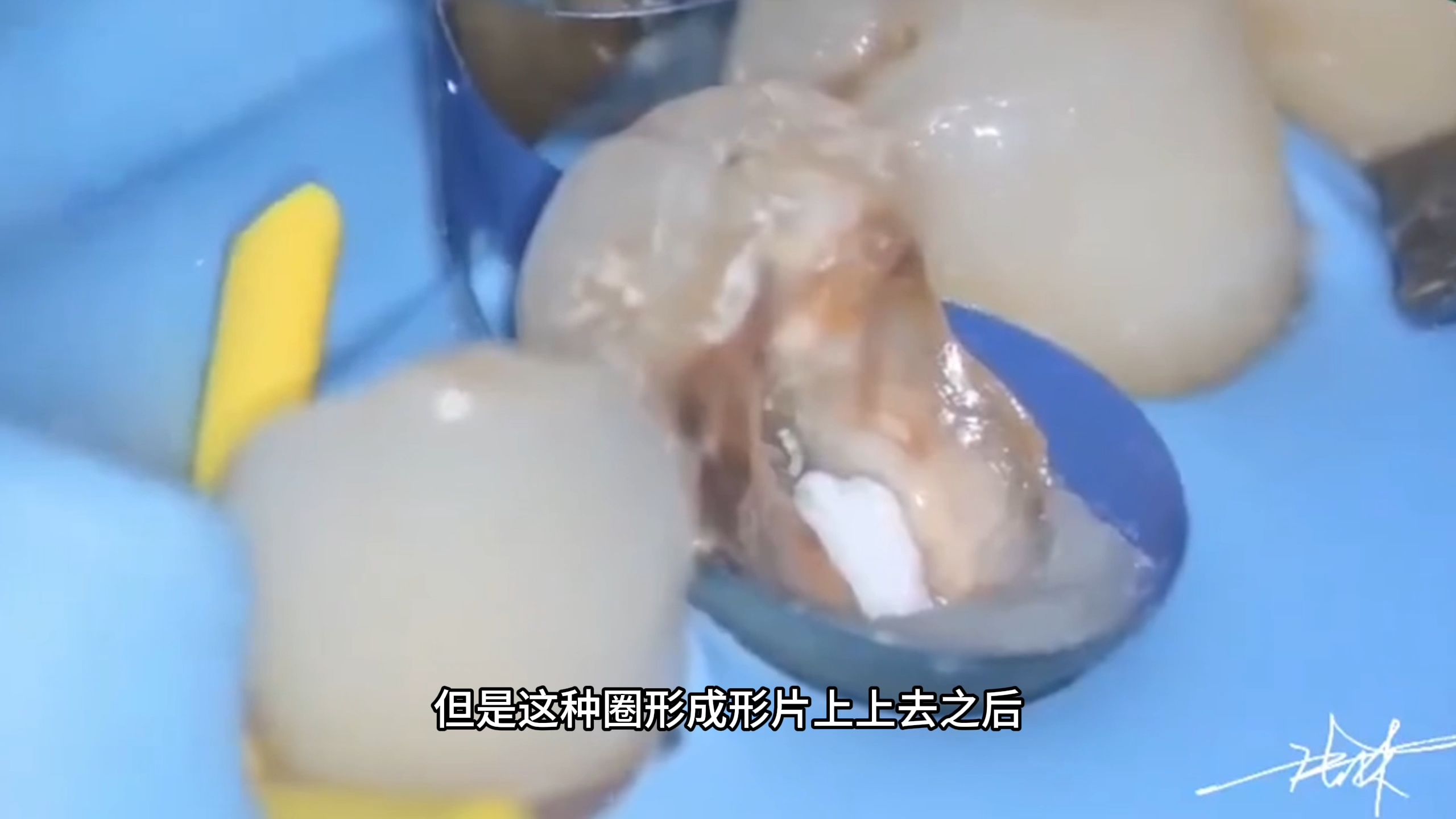 【张林】5天学会做嵌体2——龈壁提升术