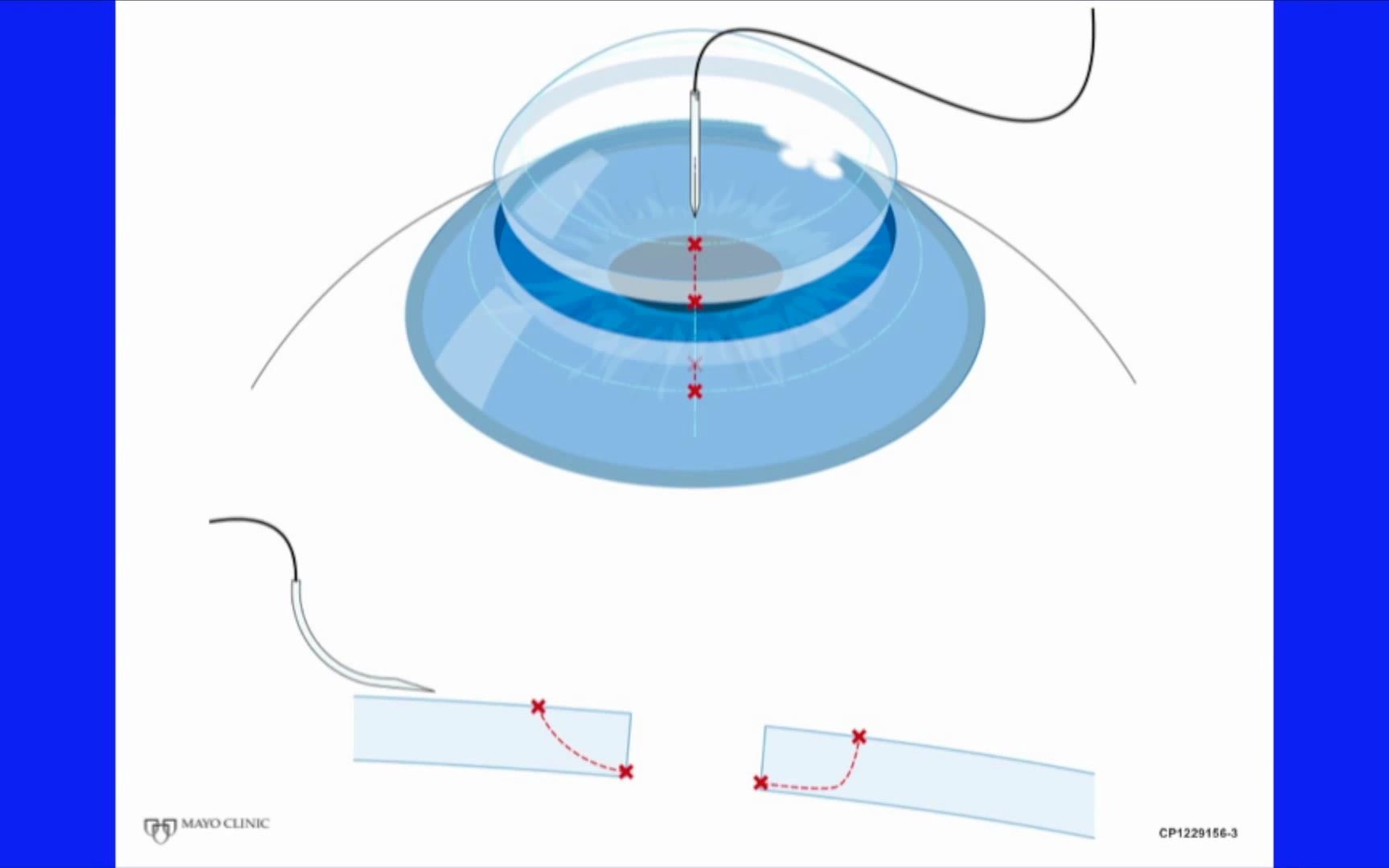 角膜缝合保姆级教学 Part 6