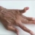 3D视频演示：类风湿关节炎的典型表现，发展到最后甚至整个手指关节都错位一般