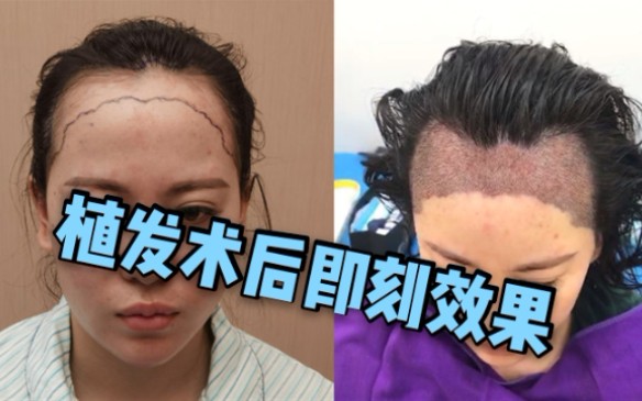 女孩植发大面积调整发际线，植发术后即刻效果。