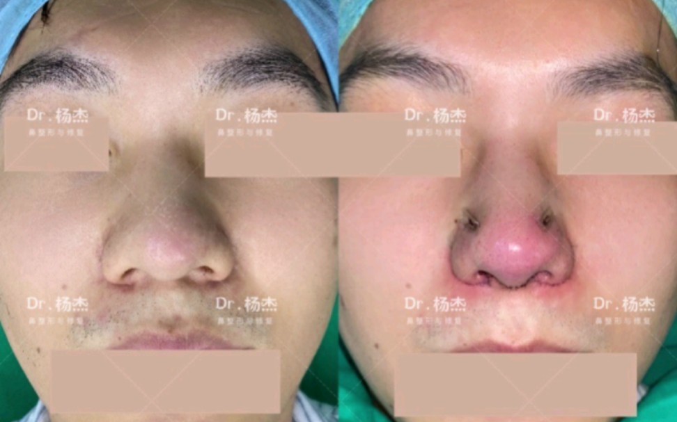 大鼻头缩小案例分享，组织肥厚+软骨肥大型大鼻头如何解决？