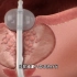 不手术治疗前列腺增生，前列腺增生的微波热疗，3D演示。。