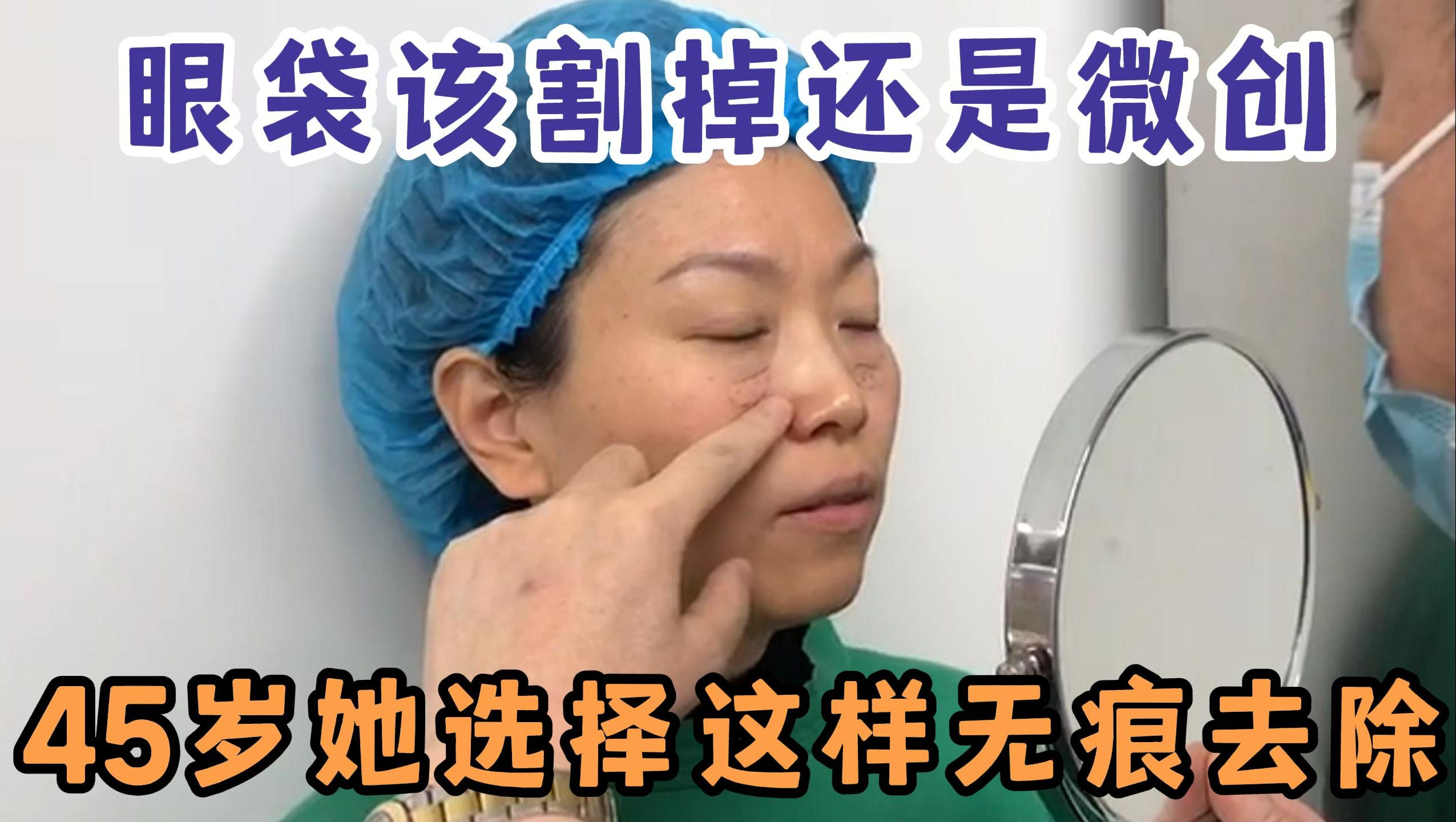 30分钟微创去眼袋泪沟，45岁女士10天无痕恢复，术后效果展示