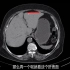 CT教学入门（9）：上腹部CT怎么看？