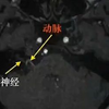 王平医生讲解面肌痉挛的症状表现