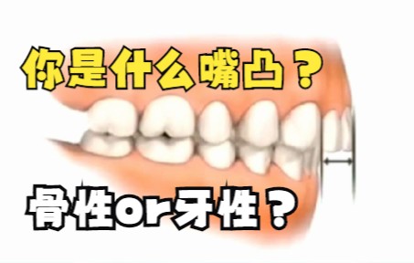 骨性嘴凸和牙性嘴凸怎么矫正好？